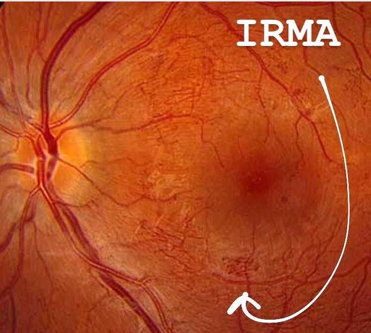 Intraretinal Microvascular Abnormalities