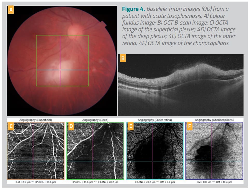 Baseline Triton images (OD) from a patient with acute toxoplasmosis