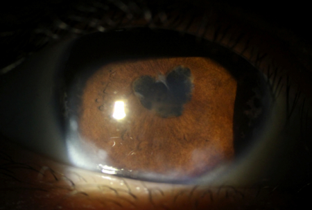 Slit lamp photo of posterior synechiae in a patient with uveitis.