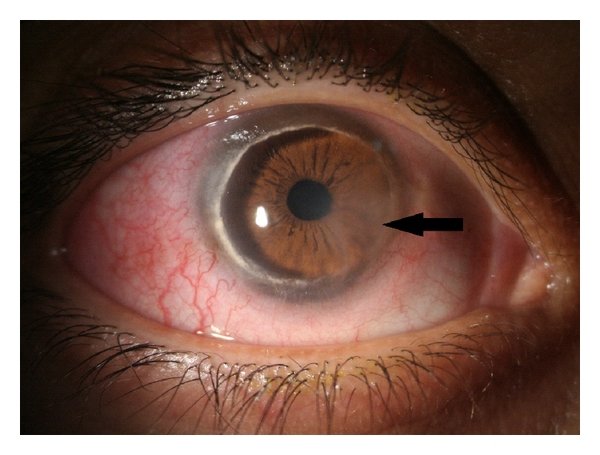 Conjunctival Injection