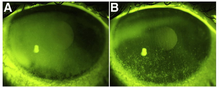 Corneal Staining