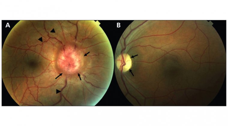 A Guide to Understanding Foster-Kennedy Syndrome