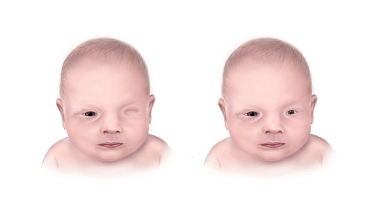 Anophthalmia: Understanding a Rare Eye Condition