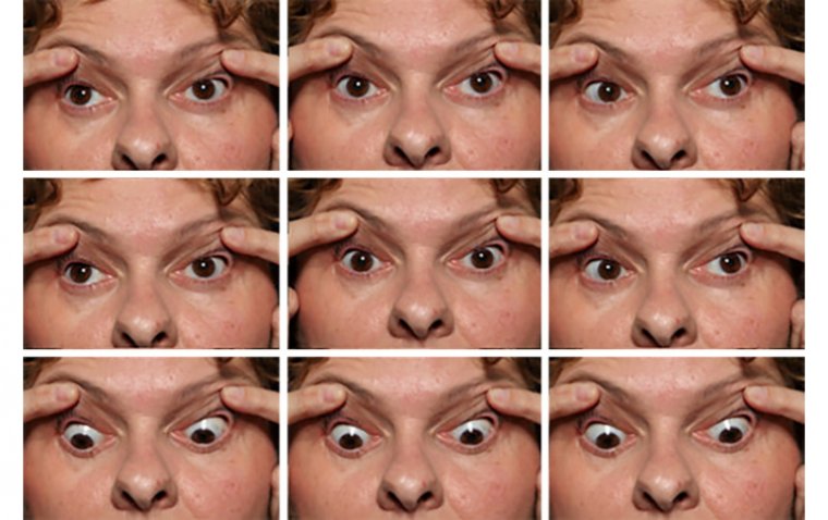 Chronic Progressive External Ophthalmoplegia (CPEO)