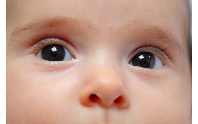 Congenital Eye Diseases: Causes, Symptoms, and Management