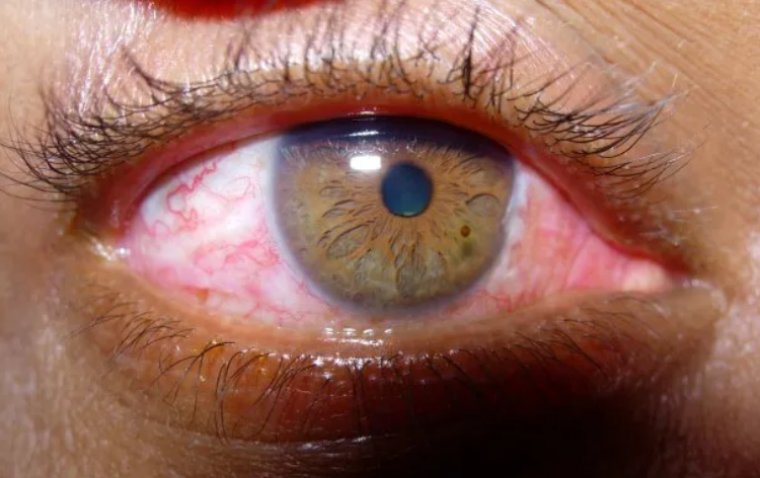 Conjunctival Injection: Causes, Symptoms and Treatment