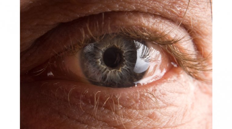 Unveiling Conjunctivochalasis: A Closer Look at the Condition