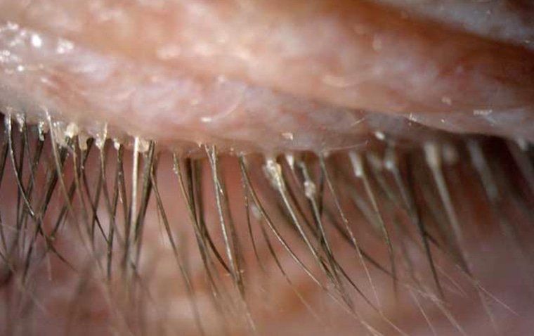 Demodex Blepharitis: Symptoms, Causes, and Effective Treatment Options