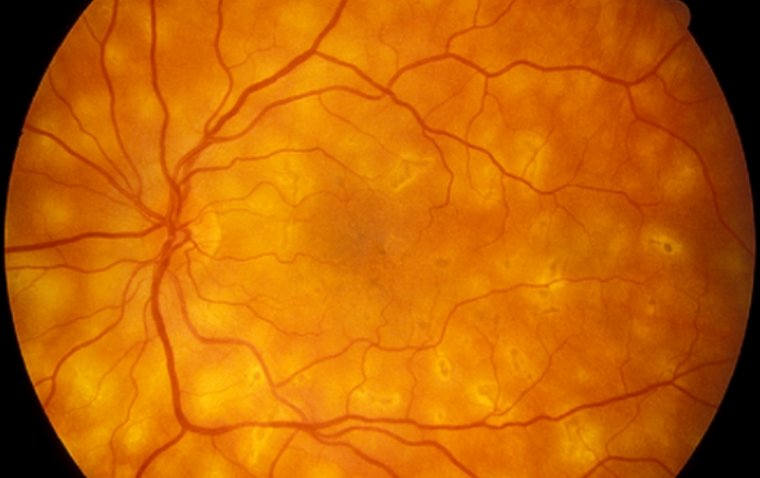 Eyes on the Sparrow: Unfolding the Mystery of Birdshot Chorioretinopathy