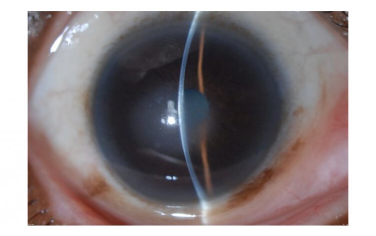 Fuchs' Dystrophy: A Comprehensive Guide to Symptoms and Management