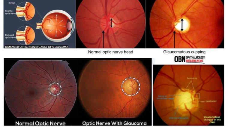 Glaucomatous Optic Nerve Damage