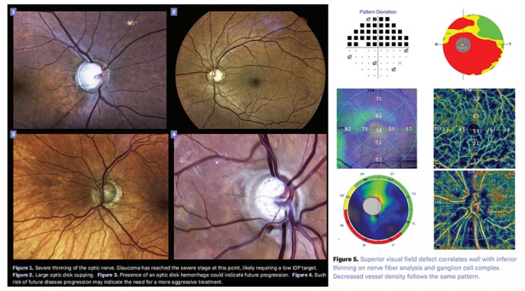 Glaucomatous Optic Neuropathy & Latest Treatments