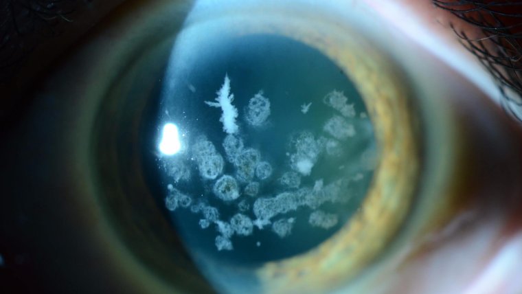 Granular Corneal Dystrophy: Exploring a Genetic Condition Affecting the Cornea