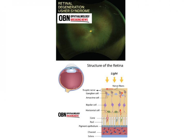 How to Deal with Usher Syndrome and Retinal Degeneration