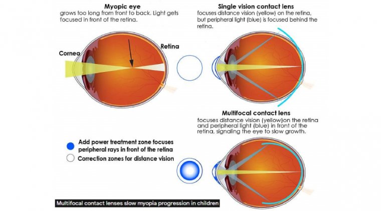 How to Slow The Myopia In Children With Contact Lenses