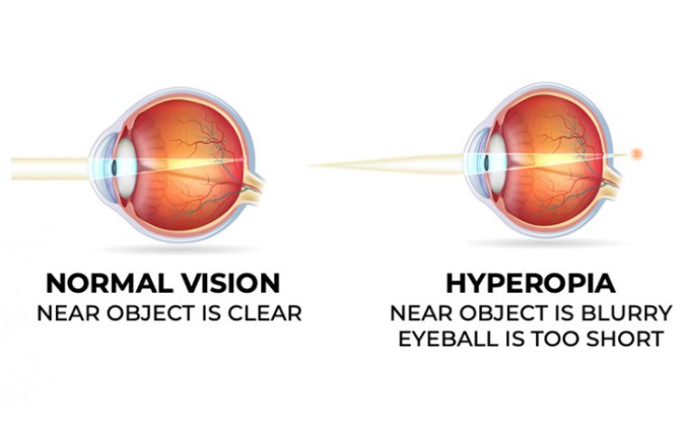 Hyperopia (Farsightedness) - Understanding the Condition
