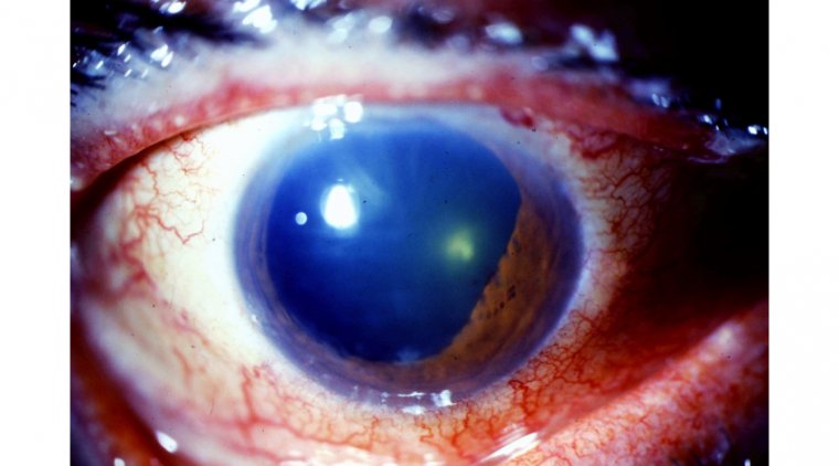 Inflammatory Glaucoma: An Overview of a Complex Condition