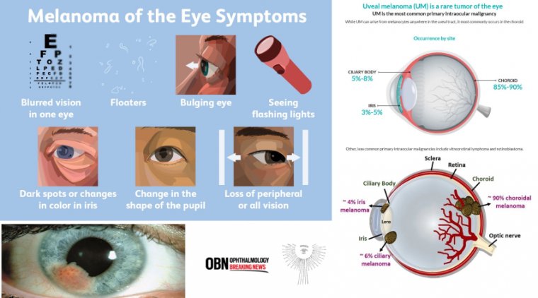Intraocular (Uveal) Melanoma Treatment