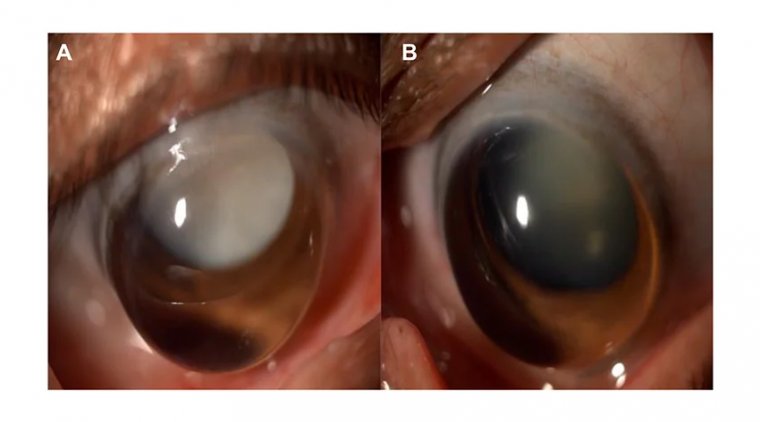 Understanding Intumescent Cataracts: A Brief Overview