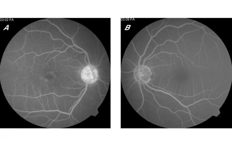 Irvine-Gass Syndrome: A Comprehensive Guide to Retinal Swelling