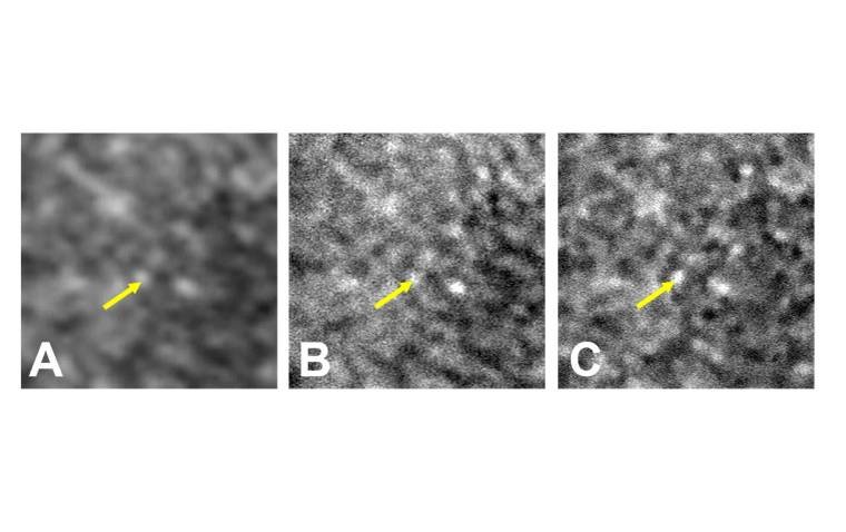 NIH Researchers Use AI to Sharpen Standard Ophthalmoscopes for High-Resolution Retinal Imaging