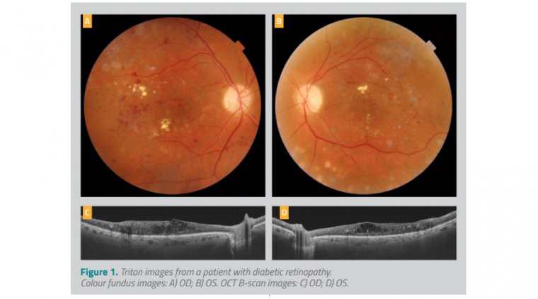 Optical coherence tomography (OCT) – Optimizing Clinical Care