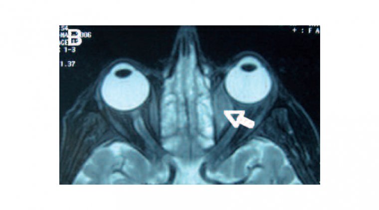 Orbital Lymphoma: Signs, Causes and Treatment