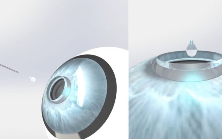 Pandorum Technologies Secures $11 Million for Corneal Blindness Treatment