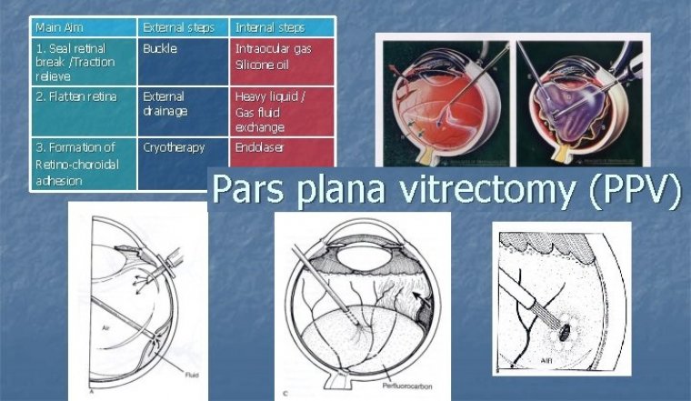 Pars Plana Vitrectomy (PPV) & Patients Education