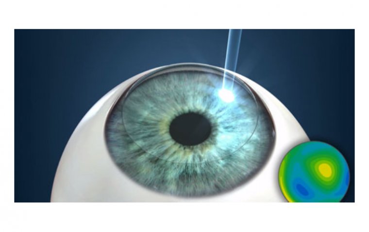 Phototherapeutic Keratectomy: Everything You Need to Know