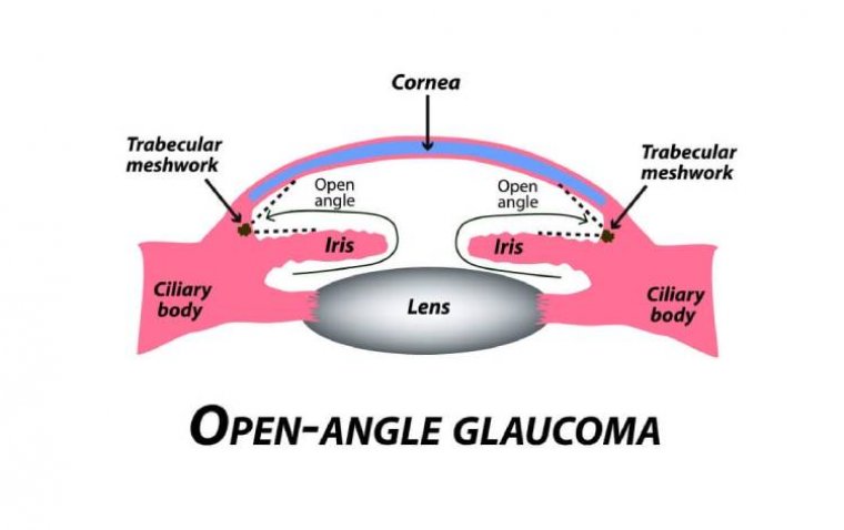 Primary Open Angle Glaucoma (POAG)