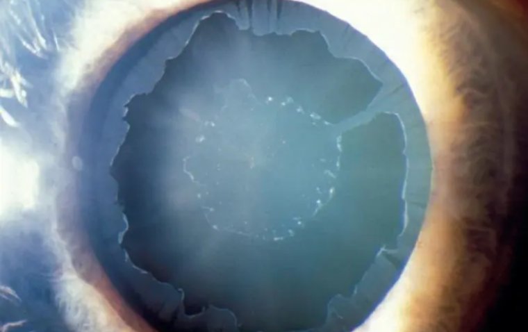 Pseudoexfoliation Syndrome: Understanding Causes, Diagnosis, and Treatment