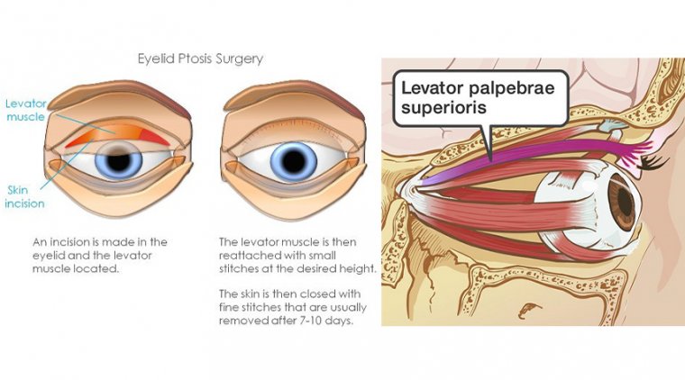 Ptosis Surgery