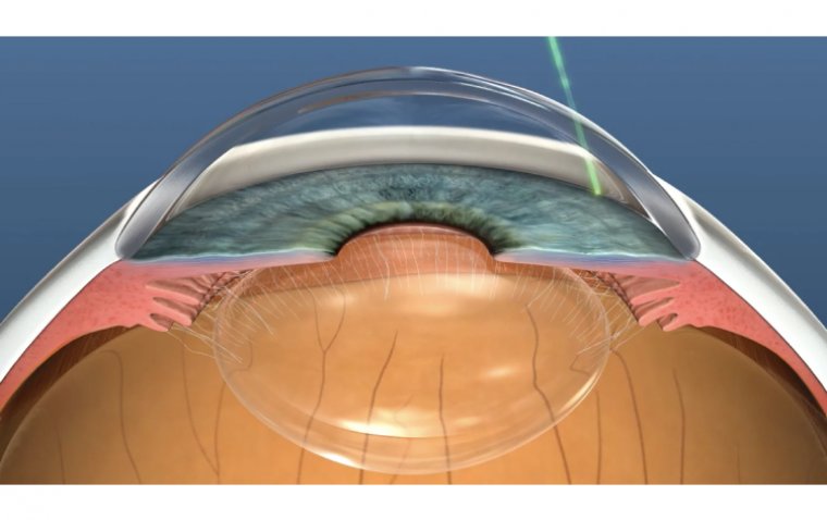 Selective Laser Trabeculoplasty (SLT) Surgery: A Comprehensive Guide