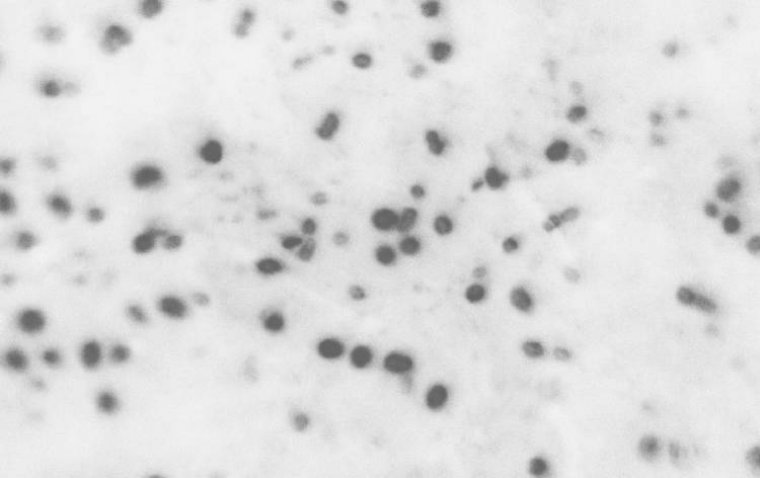 Study Reveals High Antibiotic Use Despite Guidelines for Pink Eye Treatment