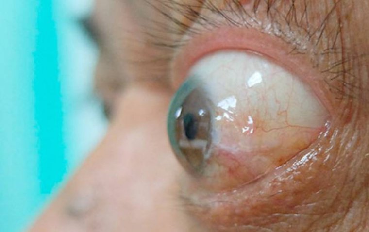 Teprotumumab Shows Long-Lasting Benefits for Thyroid Eye Disease Patients