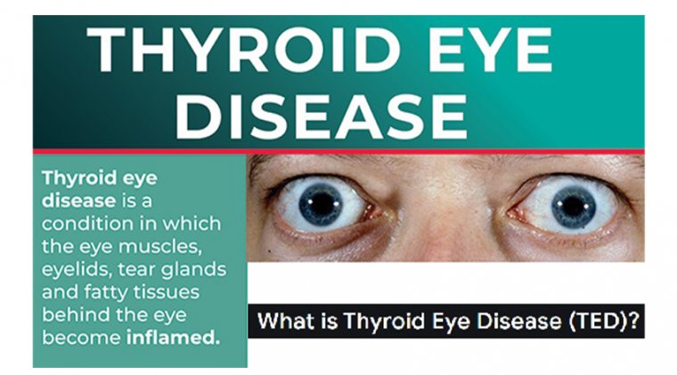 Thyroid Eye Disease (TED)