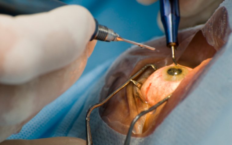 Top 6 Advances in Cataract Surgery: Transforming Vision Restoration
