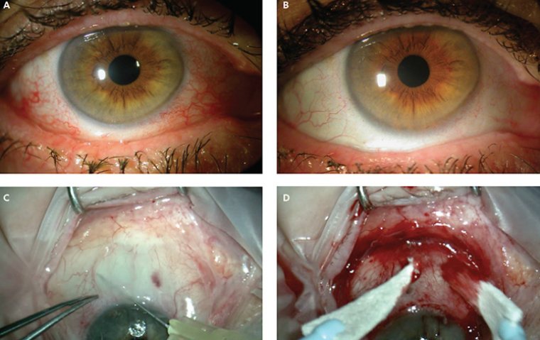 Understanding Conjunctivochalasis Surgery: A Comprehensive Guide