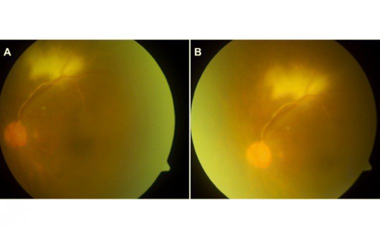 Vitritis Explained: Symptoms, Diagnosis, and Management