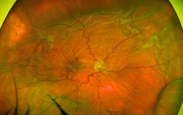 What Is Ocular Hypotony and How to Manage It