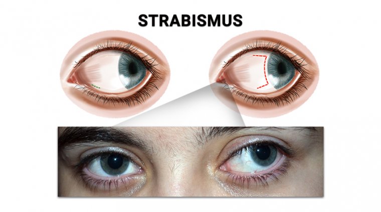 What Is Strabismus? A Comprehensive Guide for All