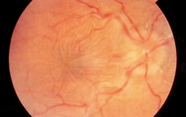 When Pressure Drops: Exploring the Enigma of Hypotony Maculopathy