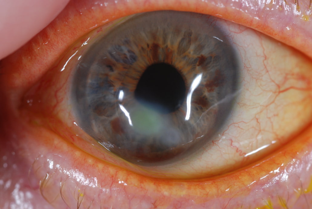 Post-LASIK Corneal Ectasia