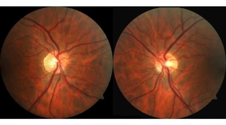 First Criteria to Diagnose Optic Neuritis