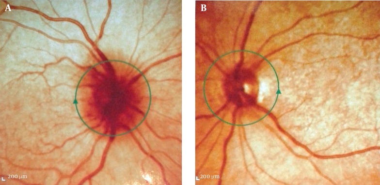 A Picture of Pseudo-Foster-Kennedy Syndrome Credit: Europe PMC