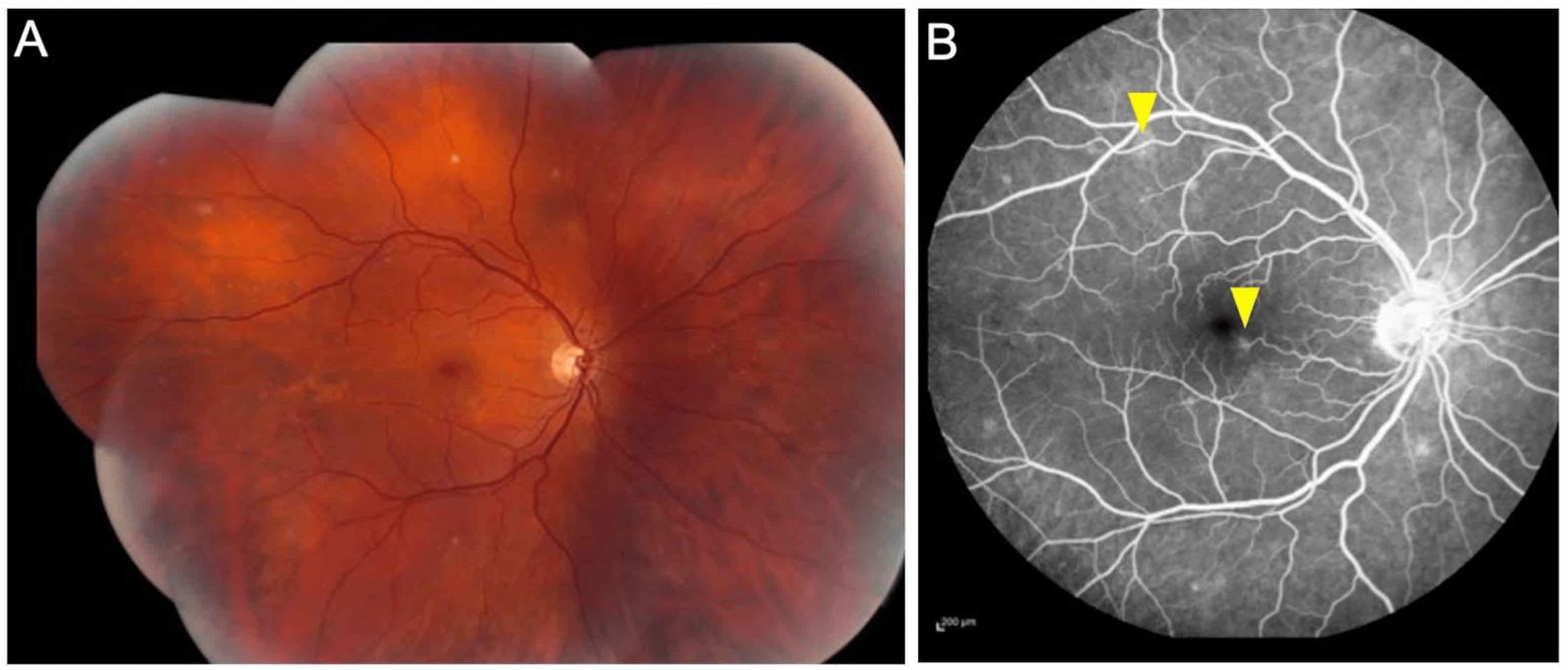 Retinal Vasculitis