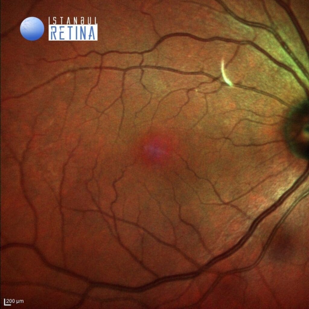 Very late onset Irvine-Gass Syndrome