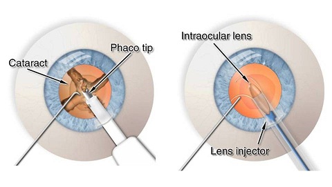 Steps of Phacoemulsification