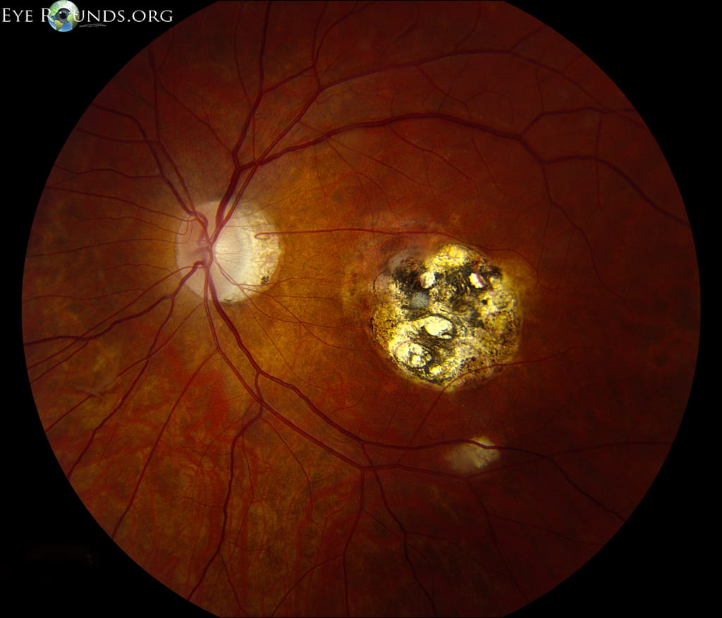 Ocular Toxoplasmosis